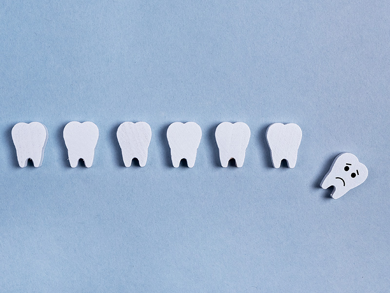 1本の歯が失われると、連鎖的に他の歯も危険にさらされる